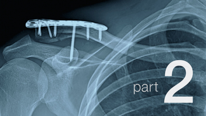 Recovering From A Broken Collarbone Part 2 05118 700×394 Recovering From A Broken Collarbone Part 2 05118 700×394